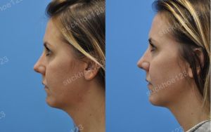 Hình ảnh Ultherapy - Hifu  trước sau Dr Tâm – ca 18