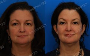 Hình ảnh Ultherapy - Hifu  trước sau Dr Tâm – ca 19