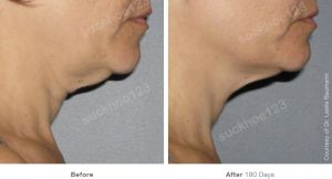 Hình ảnh Ultherapy - Hifu  trước sau Dr Tâm – ca 27