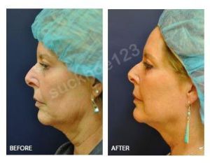 Hình ảnh Ultherapy - Hifu  trước sau Dr Tâm – ca 3