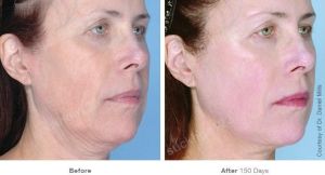 Hình ảnh Ultherapy - Hifu  trước sau Dr Tâm – ca 38