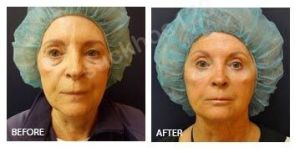 Hình ảnh Ultherapy - Hifu  trước sau Dr Tâm – ca 4