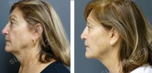 Hình ảnh Ultherapy - Hifu  trước sau Dr Tâm – ca 41