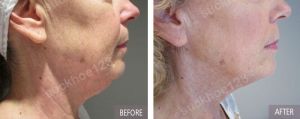 Hình ảnh Ultherapy - Hifu  trước sau Dr Tâm – ca 42