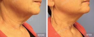 Hình ảnh Ultherapy - Hifu  trước sau Dr Tâm – ca 43