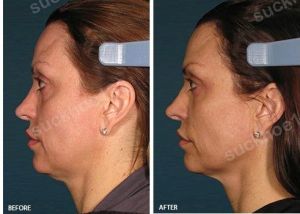 Hình ảnh Ultherapy - Hifu  trước sau Dr Tâm – ca 6