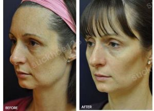 Hình ảnh Ultherapy - Hifu  trước sau Dr Tâm – ca 1