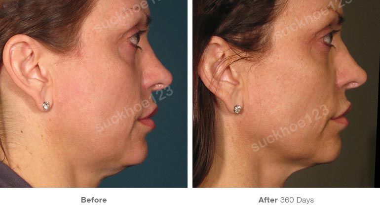 ultherapy truoc sau vung mat 1 suckhoe123