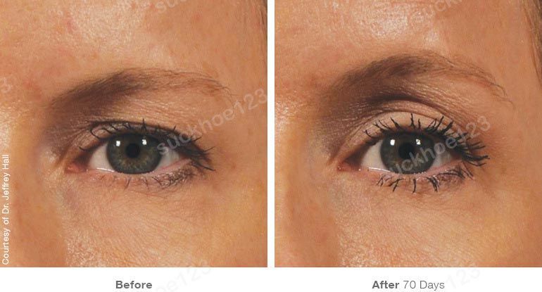 ultherapy truoc sau vung mat 3 suckhoe123