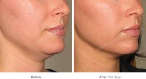 Hình ảnh Ultherapy - Hifu  trước sau Dr Tâm – ca 23