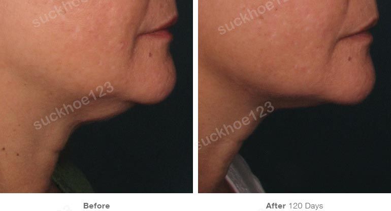ultherapy truoc sau vung mat 6 suckhoe123