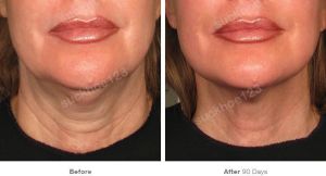 Hình ảnh Ultherapy - Hifu  trước sau Dr Tâm – ca 25
