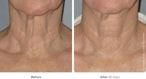 Hình ảnh Ultherapy - Hifu  trước sau Dr Tâm – ca 26