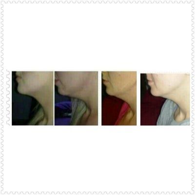 Tiêm Kybella xóa nọng cằm di truyền ở cô gái 27 tuổi
