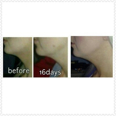 Lần đầu trong đời có được chiếc cằm thực sự với đường viền quai hàm thon gọn sau liệu trình tiêm Kybella