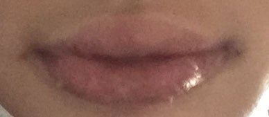 Hành trình cấy mỡ tự thân vào môi, “biến hóa” đôi môi mỏng trở nên căng mọng đầy sức sống