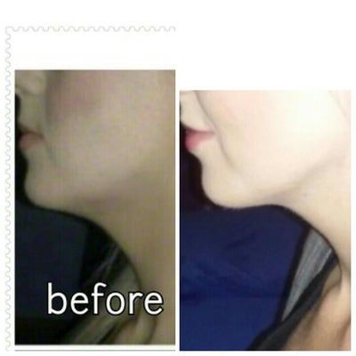 Lần đầu trong đời có được chiếc cằm thực sự với đường viền quai hàm thon gọn sau liệu trình tiêm Kybella