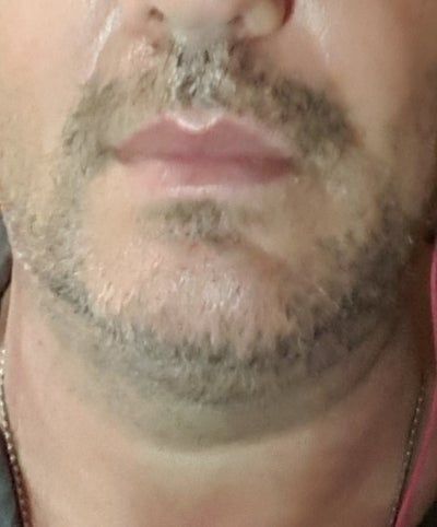 Hạnh phúc của người phụ nữ 52 tuổi đánh tan nọng cằm chỉ sau 1 lần tiêm Kybella