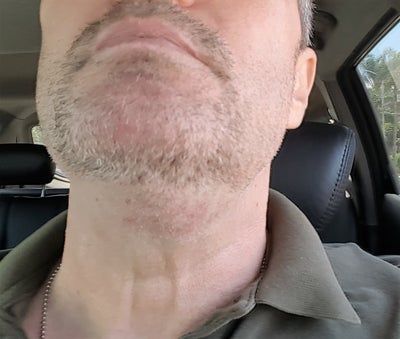 Quý ông 56 tuổi cằm ngấn mỡ, cổ không rõ đường nét với hành trình tiêm Kybella