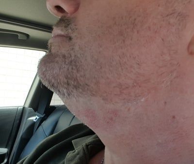 Hạnh phúc của người phụ nữ 52 tuổi đánh tan nọng cằm chỉ sau 1 lần tiêm Kybella