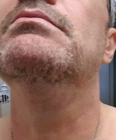 Hạnh phúc của người phụ nữ 52 tuổi đánh tan nọng cằm chỉ sau 1 lần tiêm Kybella