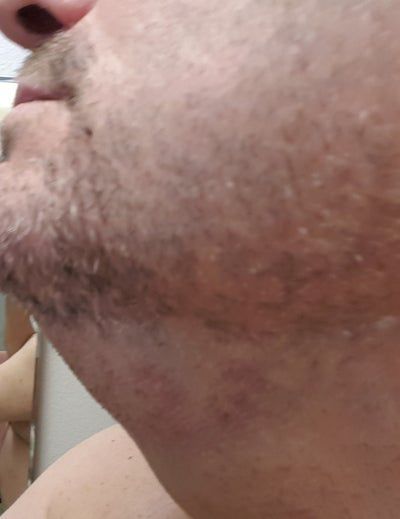 Hạnh phúc của người phụ nữ 52 tuổi đánh tan nọng cằm chỉ sau 1 lần tiêm Kybella