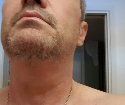 Hạnh phúc của người phụ nữ 52 tuổi đánh tan nọng cằm chỉ sau 1 lần tiêm Kybella