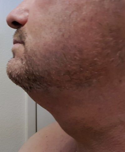 Hạnh phúc của người phụ nữ 52 tuổi đánh tan nọng cằm chỉ sau 1 lần tiêm Kybella