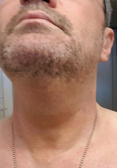 Hạnh phúc của người phụ nữ 52 tuổi đánh tan nọng cằm chỉ sau 1 lần tiêm Kybella