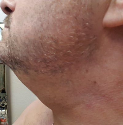 Hạnh phúc của người phụ nữ 52 tuổi đánh tan nọng cằm chỉ sau 1 lần tiêm Kybella