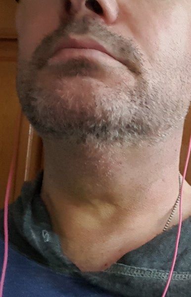 Quý ông 56 tuổi cằm ngấn mỡ, cổ không rõ đường nét với hành trình tiêm Kybella