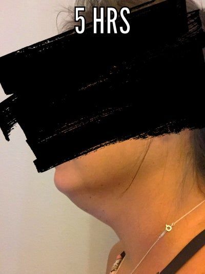 Mẹ 3 con 36 tuổi với hành trình căng da bụng toàn phần, chỉnh sửa cơ, hút mỡ