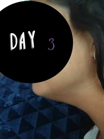 Hành trình biến hóa cổ gà tây nam tính thành cổ mảnh mai nữ tính với Kybella