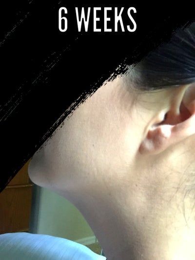 Hành trình biến hóa cổ gà tây nam tính thành cổ mảnh mai nữ tính với Kybella