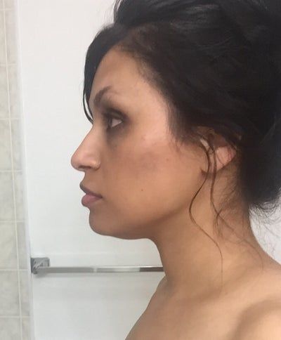 Đường viền quai hàm và khuôn mặt cô gái thay đổi rõ rệt sau khi tiêm 2 lọ Kybella