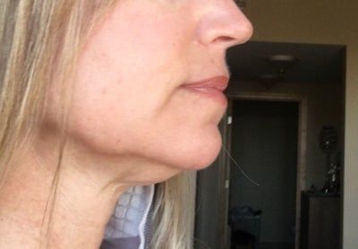Hạnh phúc của người phụ nữ 52 tuổi đánh tan nọng cằm chỉ sau 1 lần tiêm Kybella