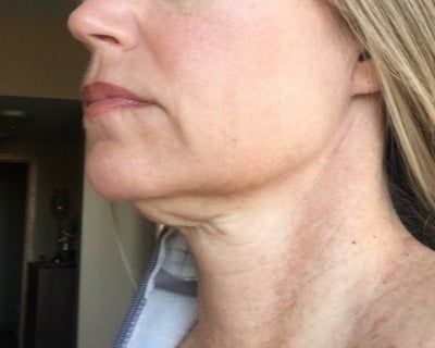 Quá trình tiêm Kybella điêu khắc vùng hàm và loại bỏ túi mỡ thừa lỏng lẻo dưới cằm