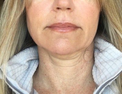 Quá trình tiêm Kybella điêu khắc vùng hàm và loại bỏ túi mỡ thừa lỏng lẻo dưới cằm