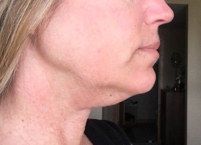 Quá trình tiêm Kybella điêu khắc vùng hàm và loại bỏ túi mỡ thừa lỏng lẻo dưới cằm