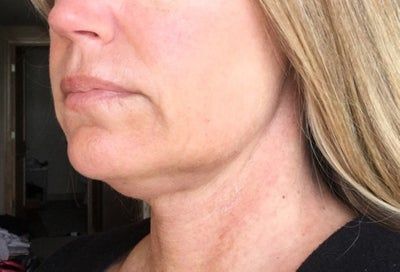 Hạnh phúc của người phụ nữ 52 tuổi đánh tan nọng cằm chỉ sau 1 lần tiêm Kybella