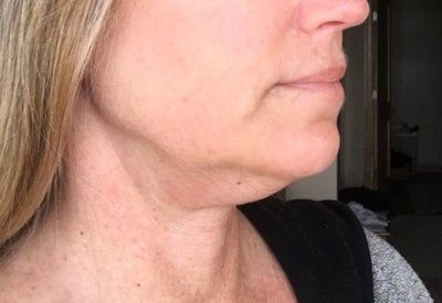Hạnh phúc của người phụ nữ 52 tuổi đánh tan nọng cằm chỉ sau 1 lần tiêm Kybella