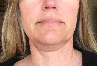 Quá trình tiêm Kybella điêu khắc vùng hàm và loại bỏ túi mỡ thừa lỏng lẻo dưới cằm