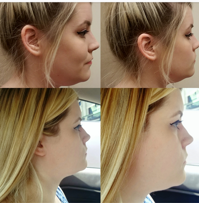 Quý ông 56 tuổi cằm ngấn mỡ, cổ không rõ đường nét với hành trình tiêm Kybella