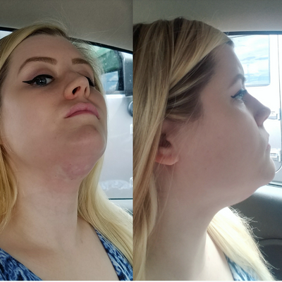 Quý ông 56 tuổi cằm ngấn mỡ, cổ không rõ đường nét với hành trình tiêm Kybella