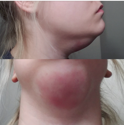 Quý ông 56 tuổi cằm ngấn mỡ, cổ không rõ đường nét với hành trình tiêm Kybella