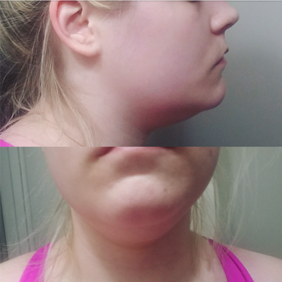Quý ông 56 tuổi cằm ngấn mỡ, cổ không rõ đường nét với hành trình tiêm Kybella