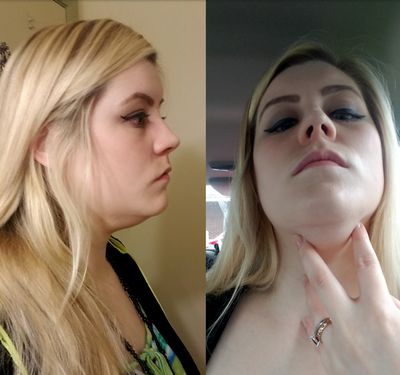 Quý ông 56 tuổi cằm ngấn mỡ, cổ không rõ đường nét với hành trình tiêm Kybella
