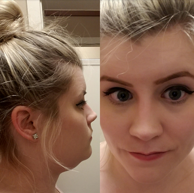 Quý ông 56 tuổi cằm ngấn mỡ, cổ không rõ đường nét với hành trình tiêm Kybella
