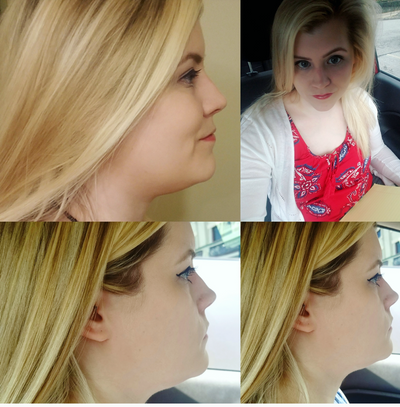 Quý ông 56 tuổi cằm ngấn mỡ, cổ không rõ đường nét với hành trình tiêm Kybella