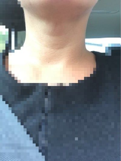 Hành trình biến hóa cổ gà tây nam tính thành cổ mảnh mai nữ tính với Kybella